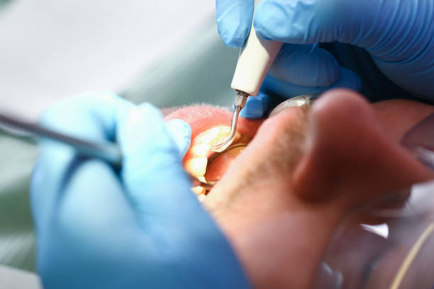 Best Knocked-Out Tooth (Avulsed Tooth) Treatment in Lakeville, MN